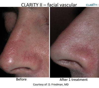 Photos avant après Laser Clarity II démontrant des résultats de traitements des télangiectasies oy vaisseaux sanguins dans le visage. 